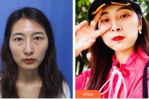 銅仁韓美時光醫(yī)療美容門診部劉真宏整形價格表附激光去眼袋案例展示