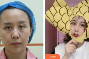 銅仁韓美時光醫(yī)療美容門診部胡曉波整形價格表附內(nèi)切祛眼袋案例展示