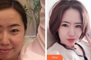 銅仁仁愛眼科醫(yī)院劉承整形價格表附眼部綜合案例展示