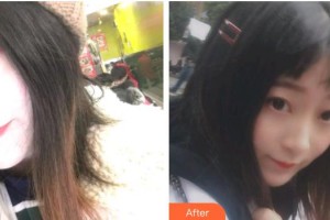 黔西南牙管家口腔醫(yī)院李景玉整形價格表附金屬托槽矯正案例展示