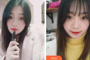 黔西南興義京州口腔醫(yī)院張雁整形價格表附牙齒隱形矯正案例展示