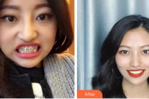 黔西南興義京州口腔醫(yī)院鄭六林整形價格表附牙齒陶瓷矯正案例展示