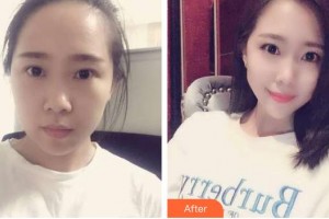 畢節(jié)西南皮膚病醫(yī)院郭惠中整形價格表附切開雙眼皮案例展示