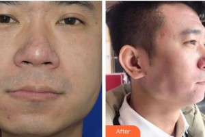 畢節(jié)市第一人民醫(yī)院燒傷整形外科張小林整形價格表附去痘印痘坑案例展示