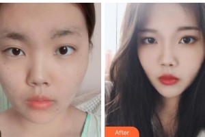 畢節(jié)市第一人民醫(yī)院燒傷整形外科徐佳麗整形價格表附光子嫩膚案例展示