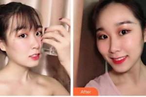 青海紅十字醫(yī)院整形美容科秦志彤整形價(jià)格表附牙齒隱形矯正案例展示