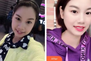 青海省人民醫(yī)院頜面整形外科趙琳整形價(jià)格表附金屬托槽矯正案例展示