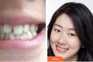 青海省人民醫(yī)院頜面整形外科劉世杰整形價(jià)格表附牙齒陶瓷矯正案例展示