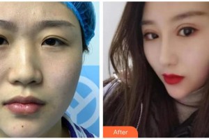 青?？等A整形醫(yī)院馮相周整形價(jià)格表附耳軟骨復(fù)合隆鼻案例展示