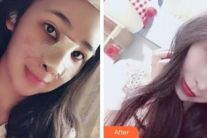 青?？等A整形醫(yī)院馬晶整形價(jià)格表附鼻部綜合案例展示