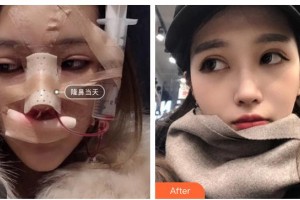 青海康華整形醫(yī)院蔡志昆整形價(jià)格表附鼻部綜合案例展示