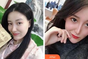 張家港康麗?？漆t(yī)院整形美容外科開學(xué)蘭住院醫(yī)師整形價(jià)格表附清潔祛痘案例展示