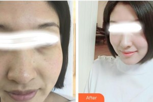 張家港康麗專科醫(yī)院整形美容外科陸玉萍整形價(jià)格表附美白嫩膚案例展示