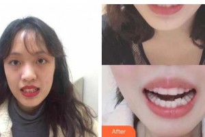 張家港康麗?？漆t(yī)院整形美容外科范立國整形價(jià)格表附牙齒隱形矯正案例展示