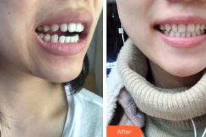 張家港萬春醫(yī)院整形美容中心朱萬春整形價(jià)格表附牙齒隱形矯正案例展示