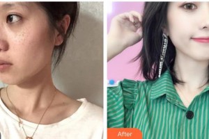 張家港容麗妍醫(yī)療美容門診部樸嘉真整形價(jià)格表附激光祛斑案例展示