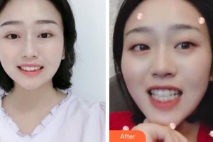 張家港康麗?？漆t(yī)院整形美容外科劉勝整形價(jià)格表附牙齒隱形矯正案例展示