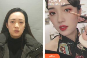 武警廣西總隊(duì)醫(yī)院醫(yī)學(xué)整形美容中心趙福德整形價(jià)格表附熱瑪吉案例展示