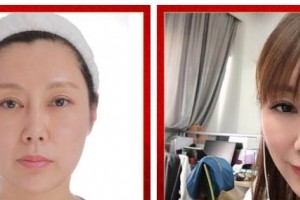 武警廣西總隊醫(yī)院醫(yī)學(xué)整形美容中心王朝生 教授整形價格表附埋線提升案例展示