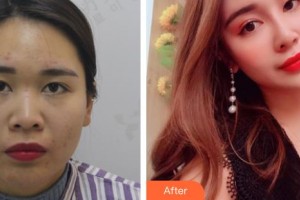 廣西醫(yī)科大學(xué)美容整形中心周翔整形價(jià)格表附耳軟骨復(fù)合隆鼻案例展示