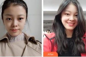 廣西愛思特整形外科醫(yī)院肖翔轅整形價(jià)格表附微針美膚案例展示