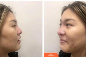 廣西壯族自治區(qū)人民醫(yī)院整形美容中心麥慧整形價(jià)格表附鼻部綜合案例展示