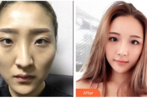 武警廣西總隊(duì)醫(yī)院醫(yī)學(xué)整形美容中心樸宰久整形價(jià)格表附假體隆鼻案例展示