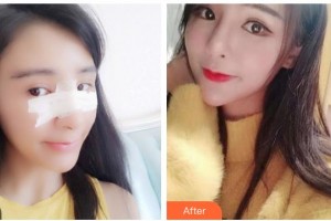 武警廣西總隊(duì)醫(yī)院醫(yī)學(xué)整形美容中心玉寶光 整形價(jià)格表附耳軟骨復(fù)合隆鼻案例展示