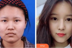 廣西中醫(yī)院第一附屬醫(yī)院美膚激光整形美容科李紅陽整形價(jià)格表附鼻部綜合案例展示