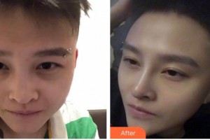 廣西中醫(yī)院第一附屬醫(yī)院美膚激光整形美容科林輝整形價格表附鼻部綜合案例展示