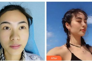 廣西東方整形美容醫(yī)院劉和平整形價格表附耳軟骨復(fù)合隆鼻案例展示