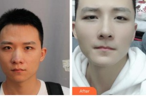 廣西醫(yī)科大學(xué)第一附屬醫(yī)院整形美容科王潤(rùn)秀整形價(jià)格表附鼻部綜合案例展示