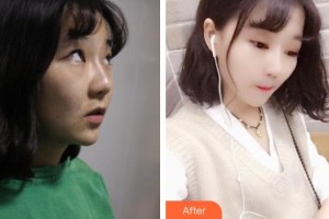 廣西中醫(yī)藥大學(xué)附屬瑞康醫(yī)院整形美容中心郭應(yīng)信整形價格表附切開雙眼皮案例展示