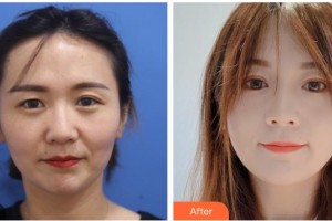 廣西中醫(yī)藥大學(xué)附屬瑞康醫(yī)院整形美容中心張素姣住院醫(yī)師整形價(jià)格表附眼部綜合案例展示