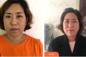 廣西中醫(yī)藥大學(xué)附屬瑞康醫(yī)院整形美容中心李莉整形價(jià)格表附切開(kāi)雙眼皮案例展示