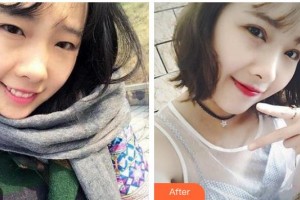 廣西中醫(yī)藥大學(xué)附屬瑞康醫(yī)院整形美容中心林忠整形價(jià)格表附切開(kāi)雙眼皮案例展示