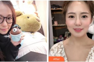 廣西東方整形美容醫(yī)院盧靜香整形價格表附金屬托槽矯正案例展示