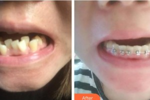 廣西科技大學(xué)第一附屬醫(yī)院骨傷整形科潘萬均整形價格表附金屬托槽矯正案例展示