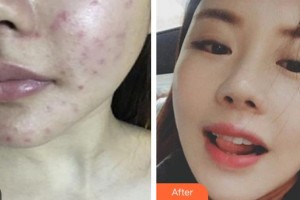 武警廣西總隊(duì)醫(yī)院醫(yī)學(xué)整形美容中心董小飛整形價(jià)格表附紅藍(lán)光祛痘案例展示