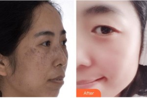 廣西科技大學(xué)第一附屬醫(yī)院骨傷整形科楊建德整形價(jià)格表附激光祛斑案例展示