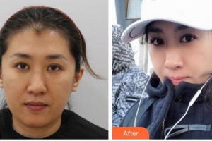 武警廣西總隊醫(yī)院醫(yī)學(xué)整形美容中心陳嘉莉整形價格表附清潔祛痘案例展示