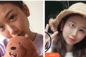 廣西東方整形美容醫(yī)院陳柳藝整形價(jià)格表附清潔祛痘案例展示