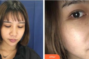 武警廣西總隊醫(yī)院醫(yī)學(xué)整形美容中心李信峰整形價格表附去痘印痘坑案例展示