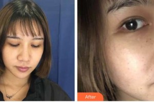 武警廣西總隊醫(yī)院醫(yī)學(xué)整形美容中心王玉燕整形價格表附去痘印痘坑案例展示