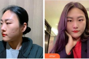 廣西醫(yī)科大學(xué)第一附屬醫(yī)院整形美容科蒙誠(chéng)躍整形價(jià)格表附清潔祛痘案例展示