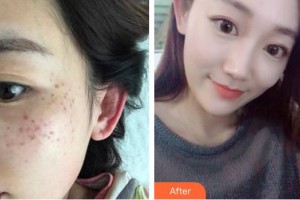 廣西愛(ài)思特整形外科醫(yī)院蘇英整形價(jià)格表附激光祛斑案例展示