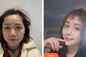 廣西東方整形美容醫(yī)院于曉倩整形價(jià)格表附埋線提升案例展示