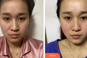 廣西愛(ài)思特整形外科醫(yī)院劉慶豐整形價(jià)格表附埋線提升案例展示