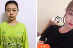 廣西愛(ài)思特整形外科醫(yī)院林泉整形價(jià)格表附埋線提升案例展示