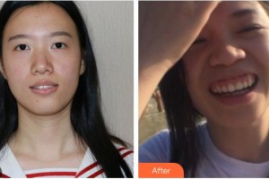 廣西愛(ài)思特整形外科醫(yī)院王遠(yuǎn)征整形價(jià)格表附牙貼面案例展示